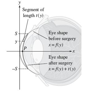 S y -S Segment of length t(y) P Eye shape before surgery x=f(y) X Eye shape after surgery x = f(y)+t(y)