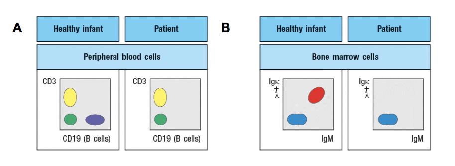 Healthy infant Patient Healthy infant Patient Peripheral blood cells Bone marrow cells CD3 CD3 CD19 (B cells) CD19 (B cells) IgM IgM