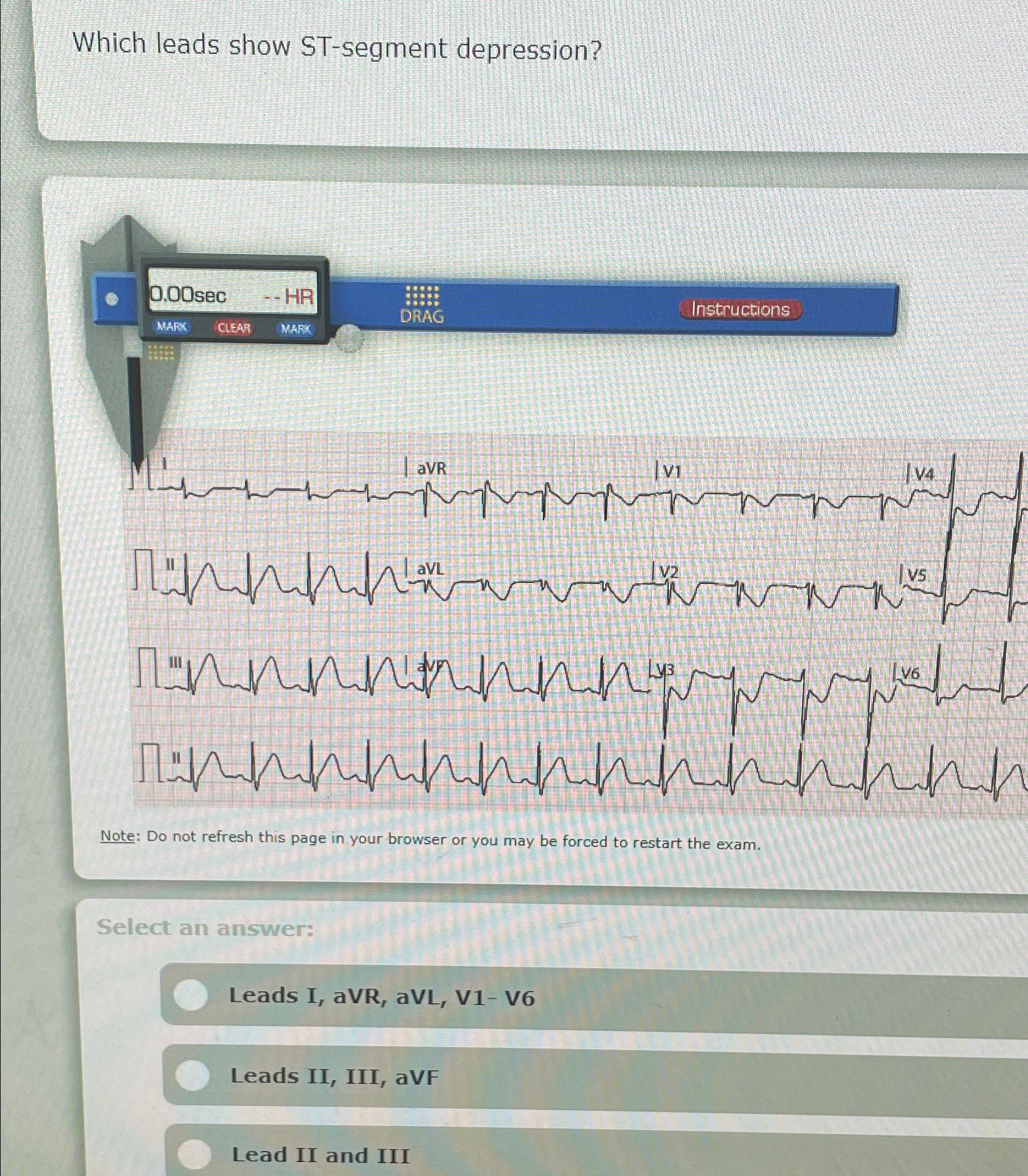  Which leads show ST-segment depression? Note: Do not refresh this page
