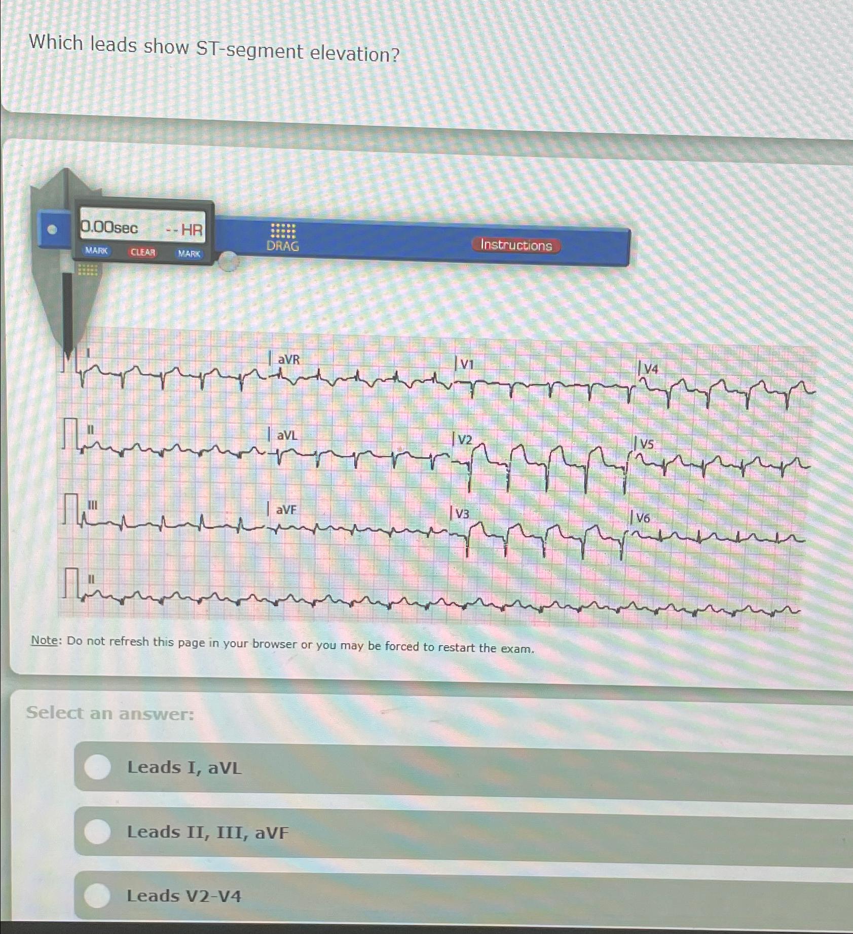  Which leads show ST-segment elevation? Note: Do not refresh this page