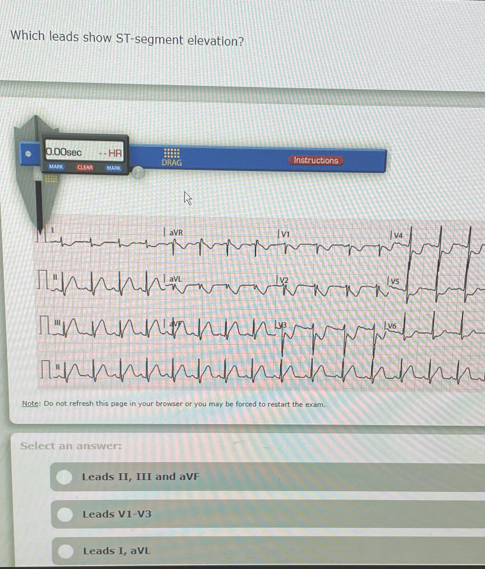  Which leads show ST-segment elevation? Note: Do not refresh this page