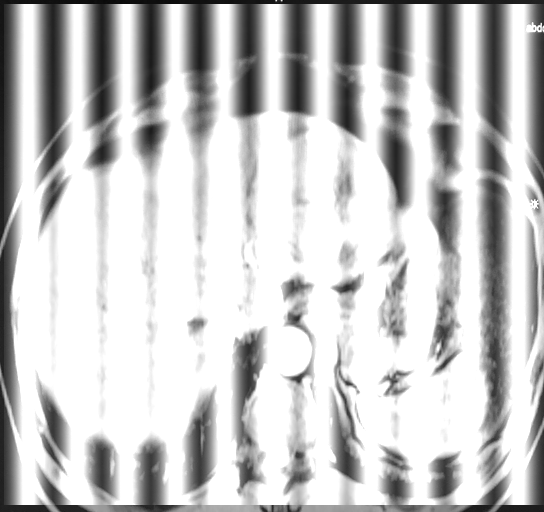 image (Artifacted) and the noise module (Pattern). Apply an image improvement technique