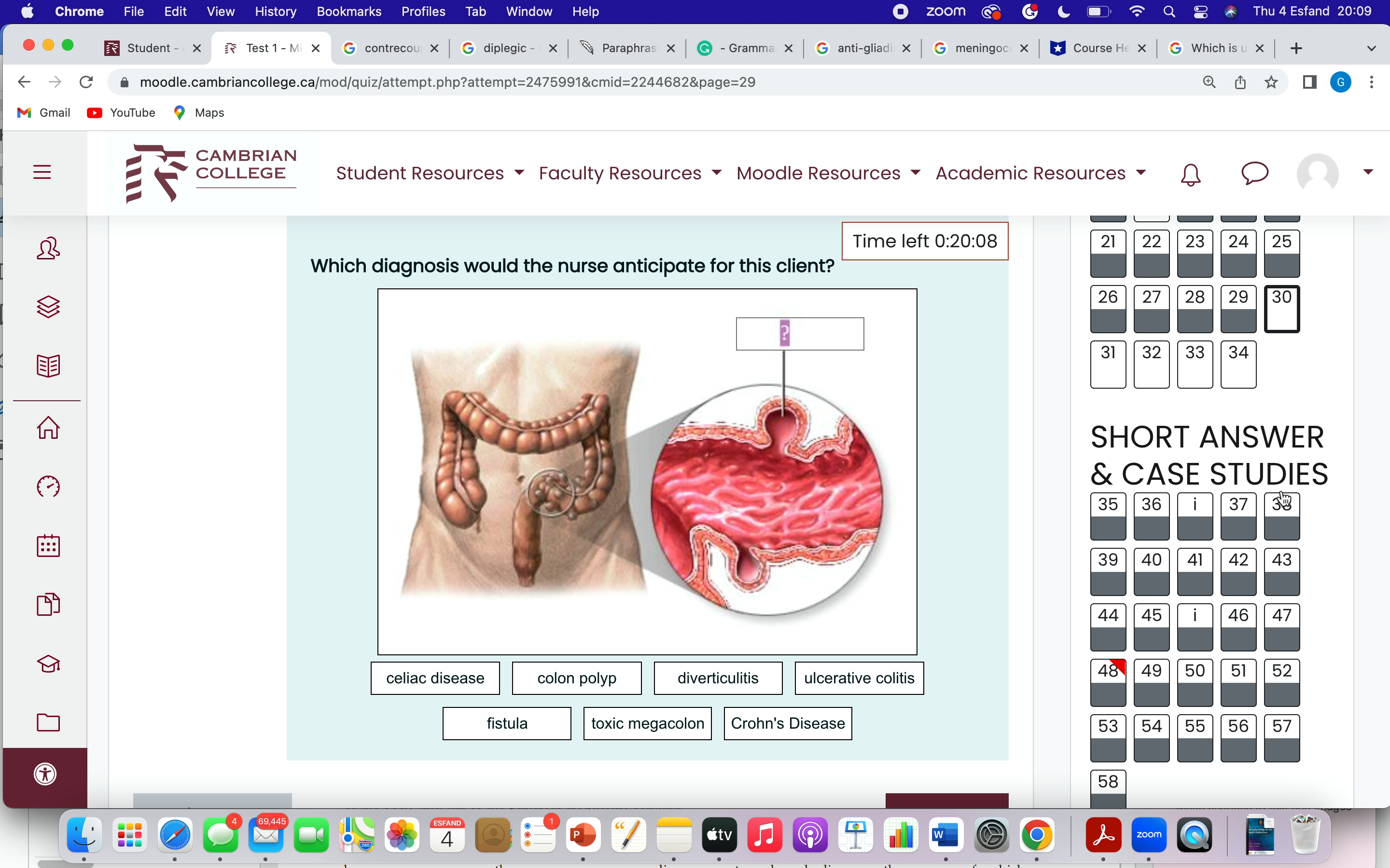 diagnosis of MODS. Marked out of 2.00 Choose... Flag renal question hyperbilirubinemia