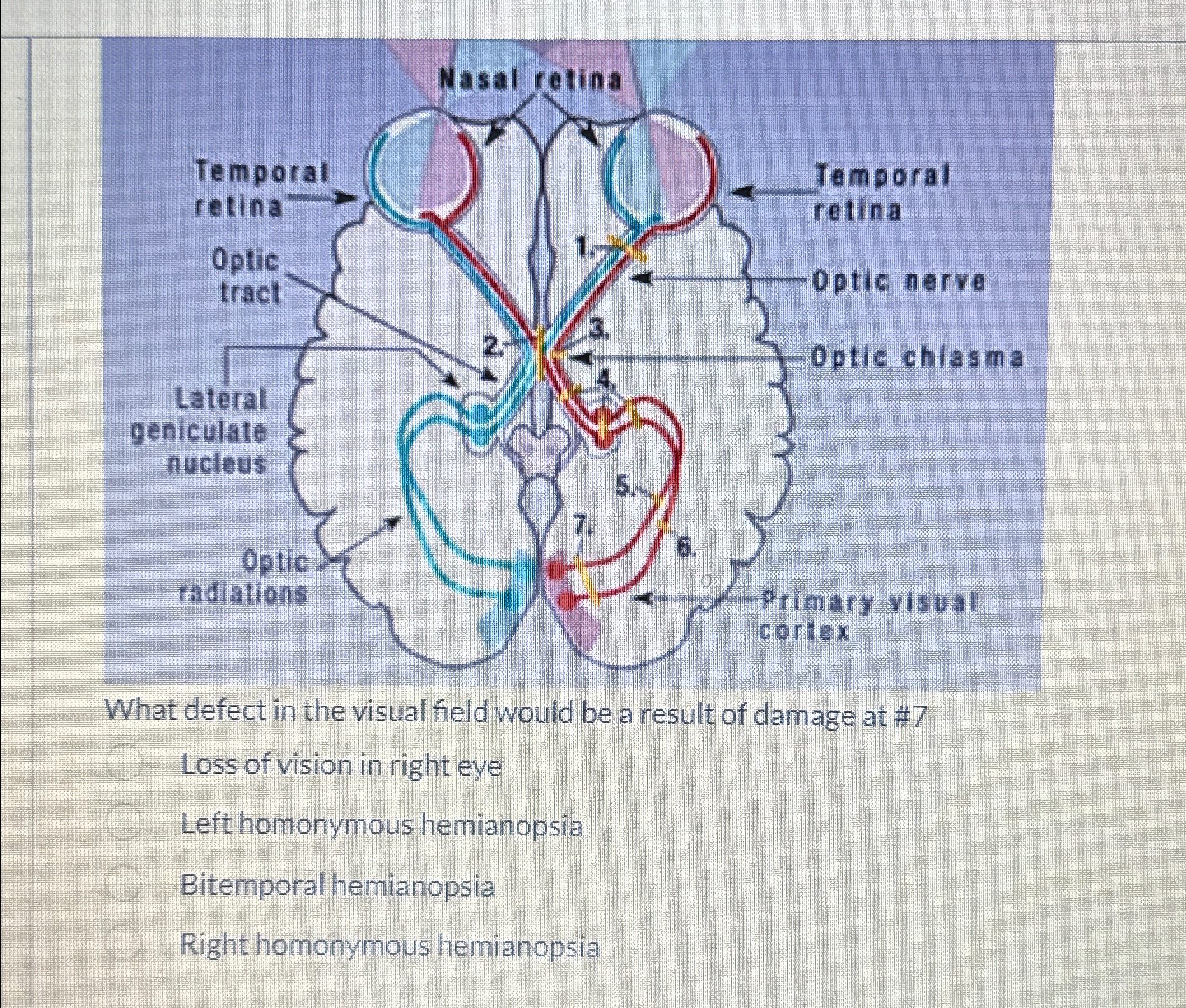  What defect in the visual field would be a result of