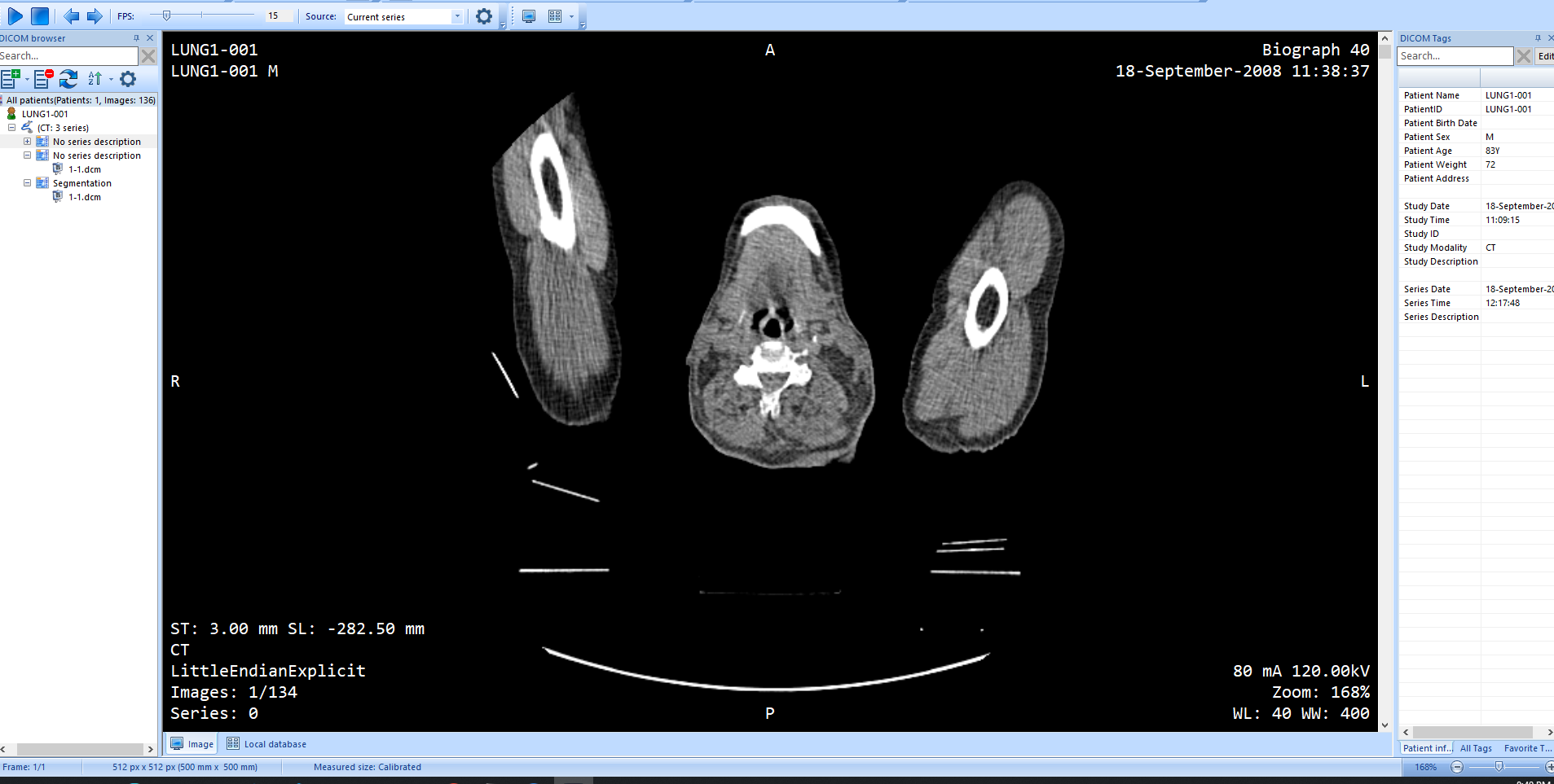 I ' m working with the NSCLC - Radiomics dataset