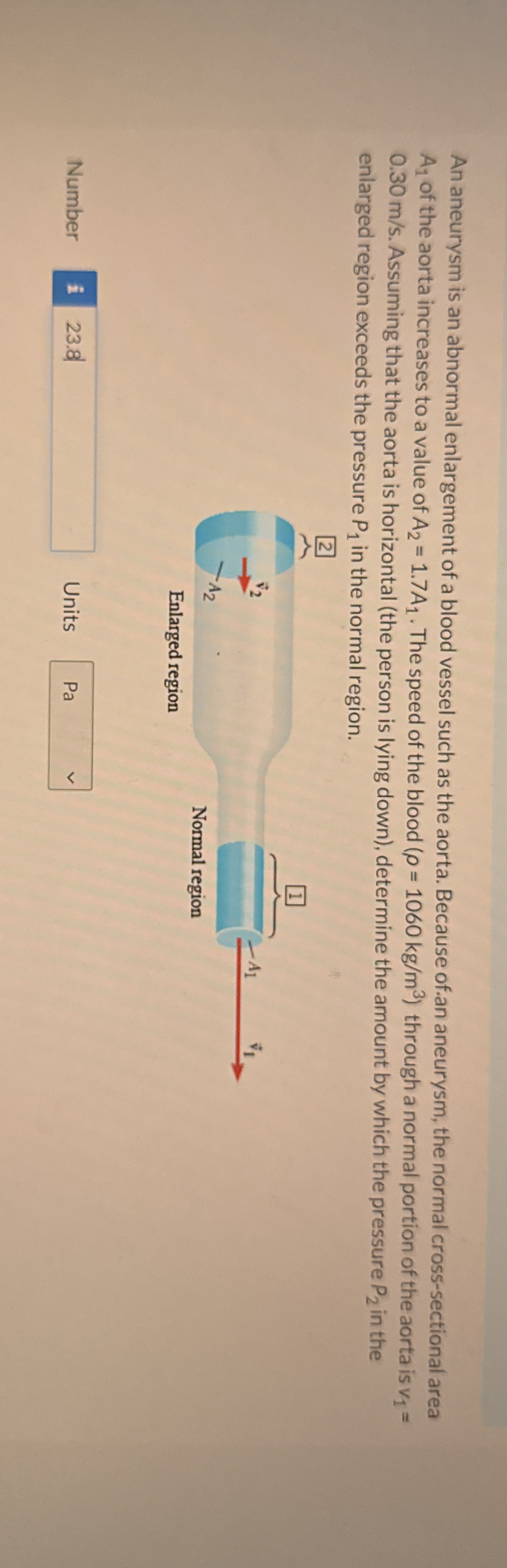 An aneurysm is an abnormal enlargement of a blood