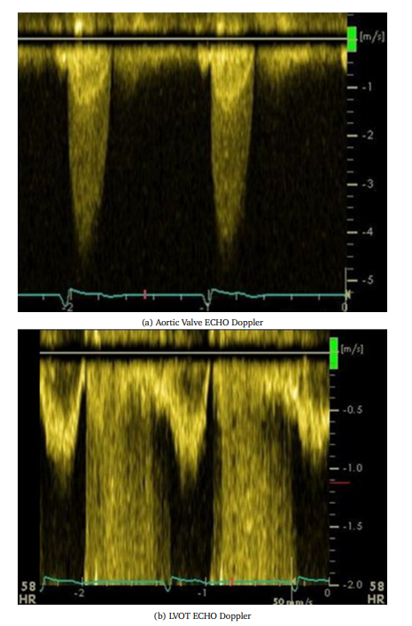 a) Read the peak aortic jet velocity, vAV,max,