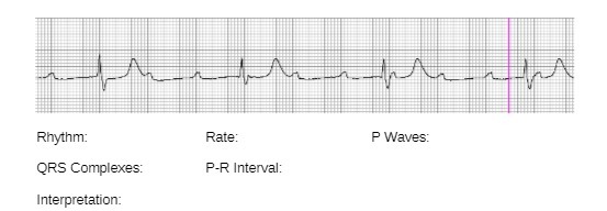 Rhythm: Rate: P Waves: QRS Complexes: P-R