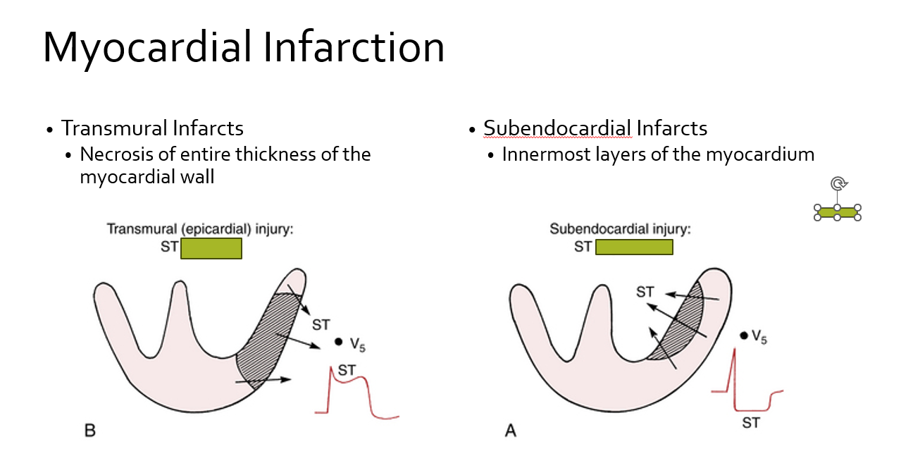 explain Myocardial Infarction . Transmural