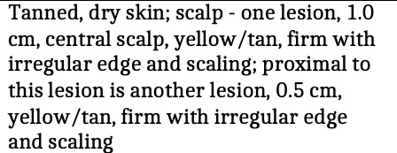 Tanned, dry skin; scalp - one lesion, 1.0 cm,