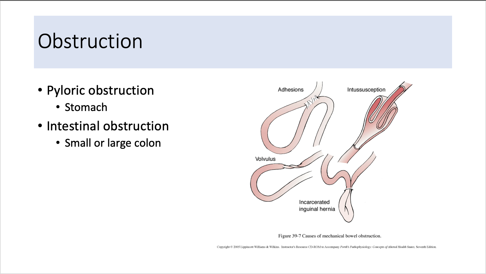 Explain in an easy way Obstruction . Pyloric