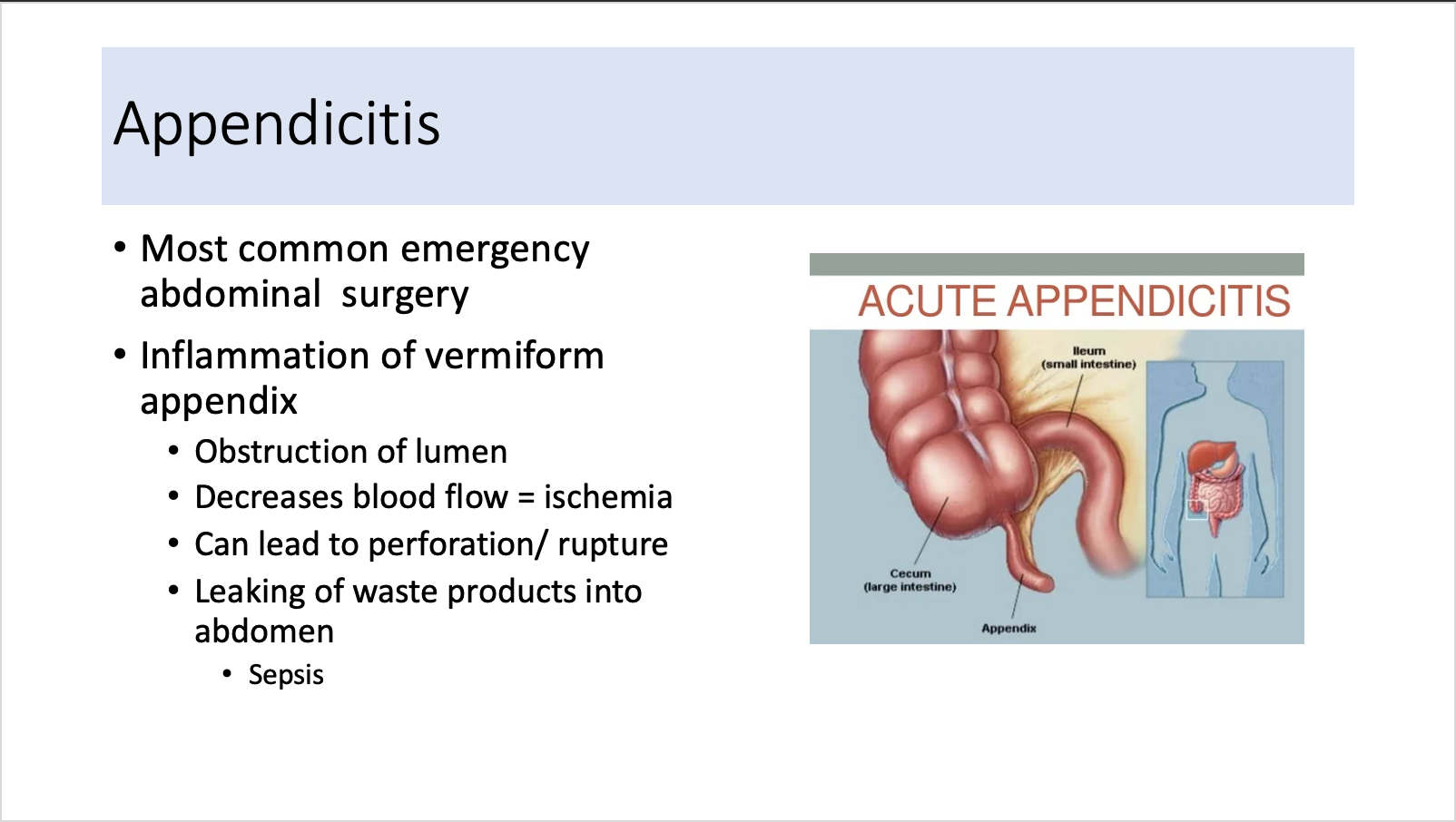 Explain in an easy way Appendicitis * Most common
