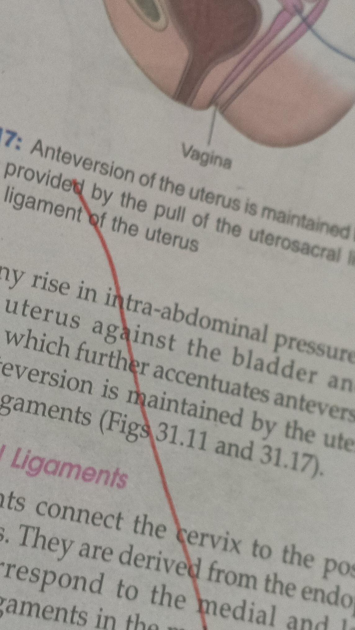 The retroversion position of uterus is an