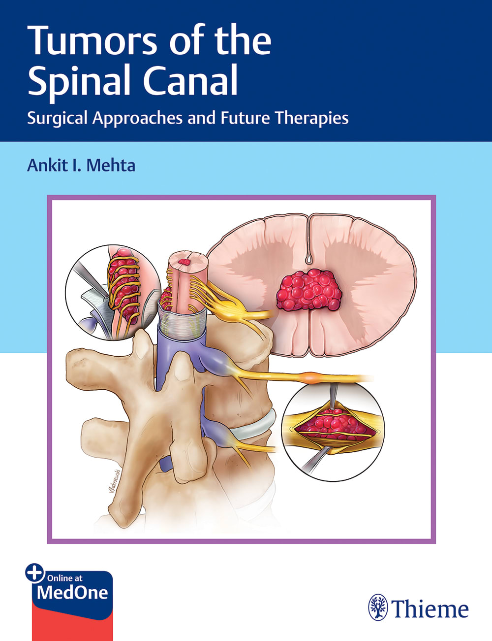 tumors of the spinal canal surgical approaches and future therapies 1st edition ankit i mehta 1626239312,