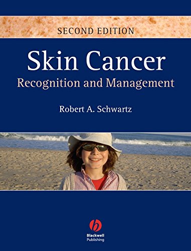 skin cancer recognition and management 2nd edition robert a.schwartz 1405159618, 9781405159616
