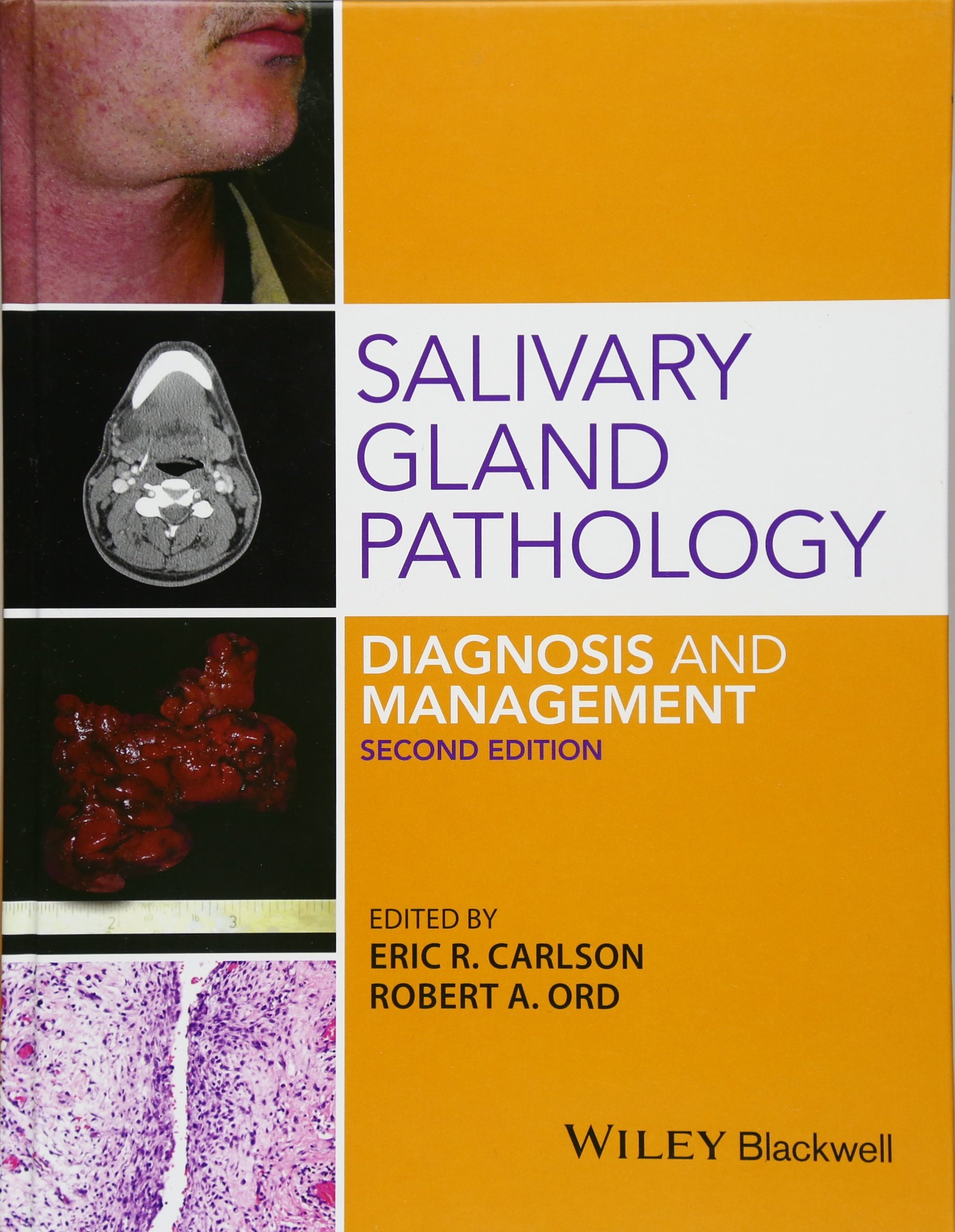 salivary gland pathology diagnosis and management 2nd edition carlson, eric r., ord, robert a. 1118933753,