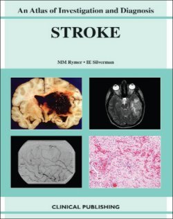 ischemic stroke an atlas of investigation and treatment 1st edition silverman, isaac e., m.d., rymer, marilyn
