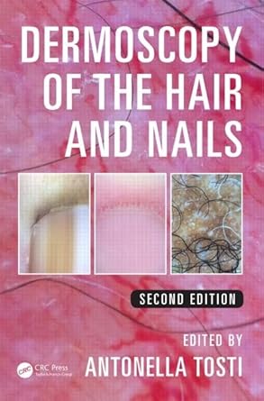 dermoscopy of the hair and nails 1st edition antonella tosti 148223405x, 978-1482234053