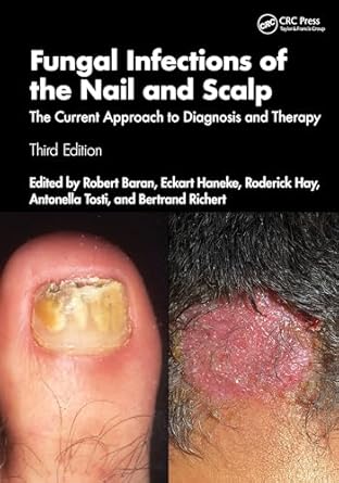 fungal infections of the nail and scalp the current approach to diagnosis and therapy 1st edition robert
