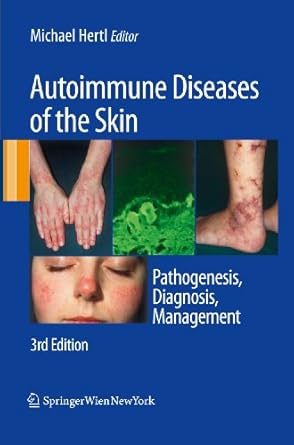autoimmune diseases of the skin pathogenesis diagnosis management 1st edition michael hertl 3211992243,