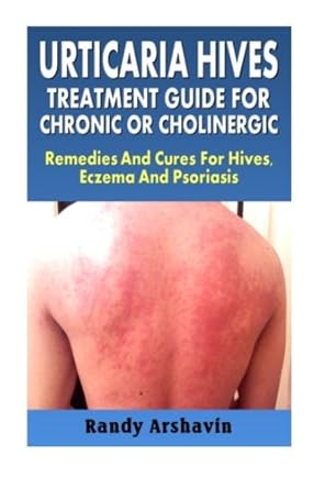 urticaria hives treatment guide for chronic or cholinergic remedies and cures for hives eczema and psoriasis