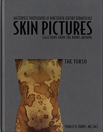 photographic history of nineteenth century dermatology selections from the burns archive the torso 1st