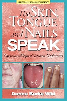 the skin tongue and nails speak observational signs of nutritional deficiencies 1st edition donna burka wild