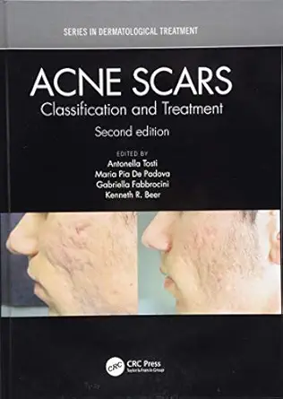 acne scars classification and treatment 1st edition antonella tosti ,maria pia de padova ,gabriella