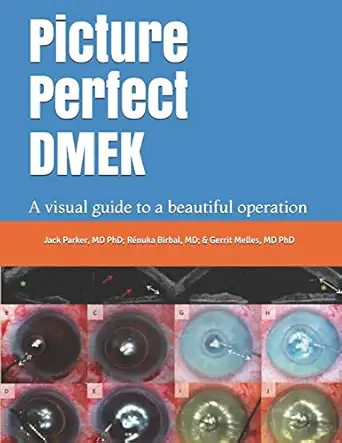 picture perfect dmek a visual guide to a beautiful operation 1st edition jack parker ,ra c nuka birbal