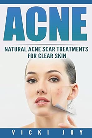 acne natural acne scar treatments for clear skin 1st edition vicki joy 1535356944, 978-1535356947