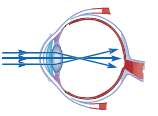 The figure shows a schematic diagram of a defective eye.