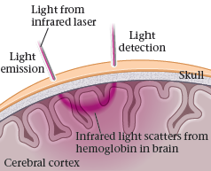 Light from infrared laser Light detection Light emission Skull Infrared light scatters from hemoglobin in brain Cerebral